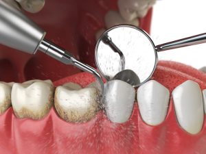 Limpieza dental con ultrasonido